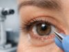Trichiasis: How to Recognize and Manage It