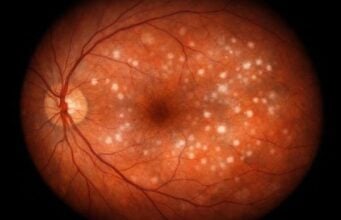 White Dot Syndromes: Detailed Overview and Insights