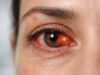 Zika Virus: Ocular Complications and Management