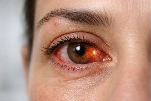 Zika Virus: Ocular Complications and Management