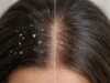 Dandruff vs dry scalp: learn the key differences, common causes, and best treatments to reduce flakes, itch, and irritation fast.