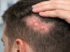 Dissecting cellulitis of the scalp causes painful nodules, drainage, and scarring hair loss. Learn causes, stages, and evidence-based treatments.