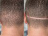 FUE vs FUT Hair Transplant: Pros, Cons, and Scarring Differences FUE vs FUT hair transplant: compare pros, cons, graft yield, recovery, and scarring differences to choose the best method for your goals.