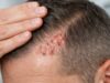 Folliculitis Decalvans: Symptoms, Diagnosis, and Treatment Options Folliculitis decalvans symptoms, diagnosis, and treatment options. Learn how to spot early scarring signs and protect remaining follicles.
