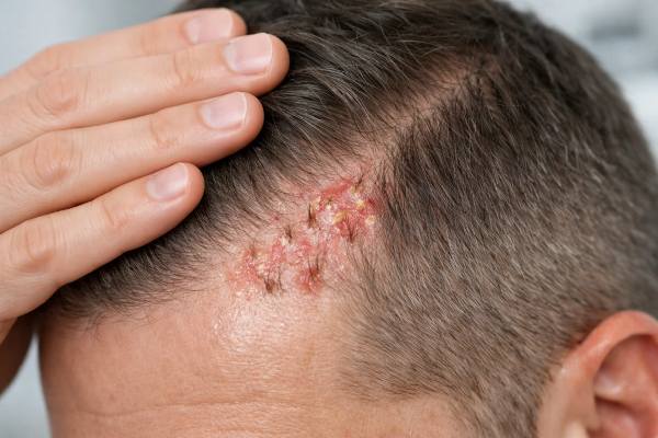 Folliculitis decalvans symptoms, diagnosis, and treatment options. Learn how to spot early scarring signs and protect remaining follicles.