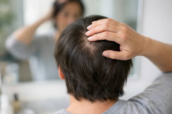 Hair thinning at the crown? Learn common causes, how to tell shedding from pattern loss, and the best treatment options for stabilizing and improving density.