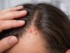 Learn what causes ingrown hairs on the scalp, how to prevent bumps after haircuts, and safe treatments to reduce pain, infection, and scarring.