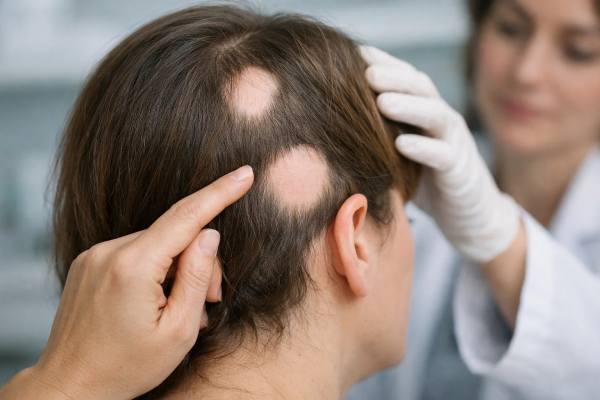 Learn how JAK inhibitors treat alopecia areata, which drugs are approved, expected regrowth timelines, key risks, and required lab monitoring.