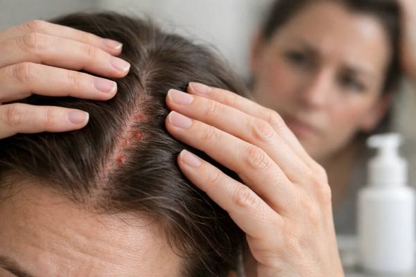 Scalp Folliculitis: Bumps, Pimples, and Treatment Options