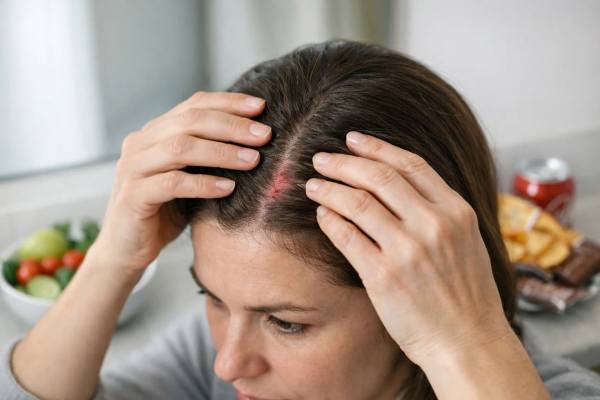 Scalp Inflammation and Diet: Sugar, Ultra-Processed Foods, and What to Change