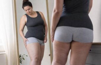 Learn how to tell lipedema from ordinary weight gain with clear signs, symptom patterns, diagnosis clues, overlap with obesity, and what actually helps next.