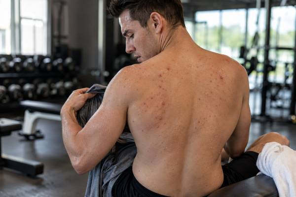 Back Acne in Men Causes, Workout Triggers, and Treatment Back acne in men often comes from oil, sweat, friction, gym gear, hormones, or products. Learn how to tell acne from other rashes and which treatments help clear it.