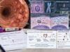 Learn how APC mutation testing relates to familial adenomatous polyposis, colon cancer risk, germline versus tumor variants, mosaicism, and family testing.