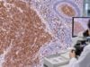 Learn what CD20-positive staining means in B-cell lymphoma, how flow cytometry and IHC differ, and why CD20 expression can change after targeted therapy.