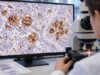 Understand what a CD30 test means in Hodgkin and T-cell lymphomas, how positive staining is interpreted, and when CD30 expression may affect diagnosis and targeted therapy.