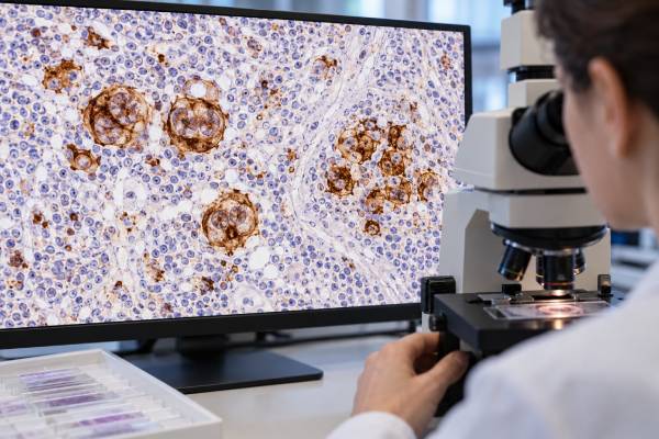 Understand what a CD30 test means in Hodgkin and T-cell lymphomas, how positive staining is interpreted, and when CD30 expression may affect diagnosis and targeted therapy.