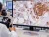 Understand what a CD34 test means in leukemia and stem cell testing, how positive blast staining is interpreted, and why CD34 alone does not diagnose acute leukemia.