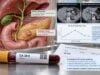 Learn what high CA 19-9 means, how pancreatic and bile duct cancers use this marker, why jaundice causes false elevations, and how Lewis status affects results.
