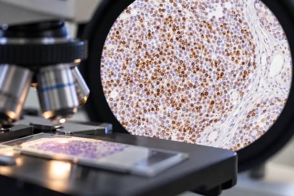 Cyclin D1 Test for Mantle Cell Lymphoma: Positive Staining and Diagnostic Meaning Learn what a cyclin D1 test means in mantle cell lymphoma, including positive nuclear staining, CCND1 rearrangements, negative results, SOX11, FISH, and key diagnostic pitfalls.