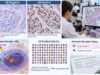 Learn how the estrogen receptor (ER) breast cancer test is scored, what ER-positive, ER-low, and ER-negative results mean, and how ER status guides treatment.