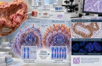 HER2 Test for Colon Cancer: HER2 Expression, Amplification, and Tumor Marker Meaning Understand HER2 Test for Colon Cancer HER2 Expression, Amplification, and Tumor Marker Meaning: what the test measures, how results are interpreted, treatment implications, limitations, and practical next steps.