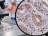 PD-L1 Test for Gastric Cancer: CPS Score, Expression Level, and Immunotherapy Marker Meaning Learn how PD-L1 CPS is calculated in gastric cancer, what CPS ≥1 and CPS ≥5 mean, and how expression level guides immunotherapy alongside HER2 and MSI testing.