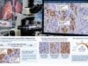 PD-L1 Test for Lung Cancer: TPS Score, Protein Expression, and Result Meaning Understand the PD-L1 test for lung cancer, including TPS score ranges, protein-expression meaning, assay differences, result limits, and how PD-L1 guides NSCLC treatment.