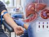 PIVKA-II Test for Liver Cancer: High Levels, HCC Risk, and Monitoring Learn what a high PIVKA-II or DCP result means, which noncancer conditions can raise it, and how the marker is used with AFP and imaging for HCC risk and monitoring.