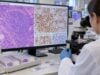Understand SOX11 testing in mantle cell lymphoma, including positive nuclear staining, cyclin D1-negative MCL, SOX11-negative subtypes, diagnosis, and prognosis.