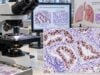 TTF-1 IHC Test for Lung Cancer: Tumor Origin, Adenocarcinoma Marker, and Positive Staining Learn how the TTF-1 IHC test helps identify lung adenocarcinoma, what positive or negative nuclear staining means, and why other markers are needed.