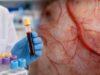Learn what a VEGF blood test measures, why serum and plasma differ, how platelets affect results, its role in POEMS syndrome, and what high levels can mean.