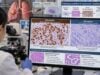 p40 IHC Test for Lung Cancer: Squamous Cell Marker, Tumor Classification, and Positive Staining Learn how p40 IHC helps classify lung squamous cell carcinoma, what positive nuclear staining means, how p40 compares with p63 and TTF-1, and its key limitations.