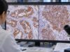 ALK IHC Test: ALK Protein Expression, Lung Cancer, Lymphoma, and Fusion Screening Learn what an ALK IHC test detects, how ALK positivity is interpreted in lung cancer and lymphoma, and when FISH or NGS is used to confirm an ALK fusion.
