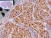 Arginase-1 IHC Test: Liver Cancer Marker, Hepatocellular Differentiation, and Tumor Origin Learn how the arginase-1 IHC test supports hepatocellular carcinoma, what positive staining means, and how it helps distinguish liver origin from metastatic tumors.