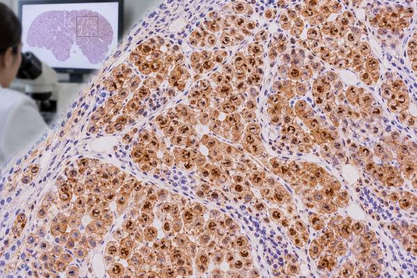 Arginase-1 IHC Test Liver Cancer Marker, Hepatocellular Differentiation, and Tumor Origin Learn how the arginase-1 IHC test supports hepatocellular carcinoma, what positive staining means, and how it helps distinguish liver origin from metastatic tumors.