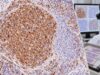 Learn what BCL2 IHC positivity means in follicular lymphoma and DLBCL, how BCL2 relates to MYC, and why protein expression is different from a gene rearrangement.
