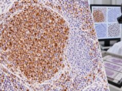 BCL2 IHC Test: Lymphoma Marker, Positive Staining, and Prognosis Meaning Learn what BCL2 IHC positivity means in follicular lymphoma and DLBCL, how BCL2 relates to MYC, and why protein expression is different from a gene rearrangement.