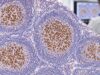 Learn what BCL6 IHC positive staining means, how BCL6 identifies germinal-center patterns in lymphoma, and why BCL6 protein expression differs from gene rearrangement.