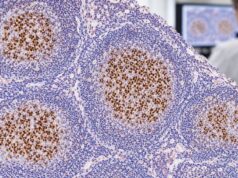 BCL6 IHC Test: Lymphoma Marker, Germinal Center Pattern, and Positive Staining Learn what BCL6 IHC positive staining means, how BCL6 identifies germinal-center patterns in lymphoma, and why BCL6 protein expression differs from gene rearrangement.