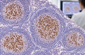 BCL6 IHC Test: Lymphoma Marker, Germinal Center Pattern, and Positive Staining Learn what BCL6 IHC positive staining means, how BCL6 identifies germinal-center patterns in lymphoma, and why BCL6 protein expression differs from gene rearrangement.