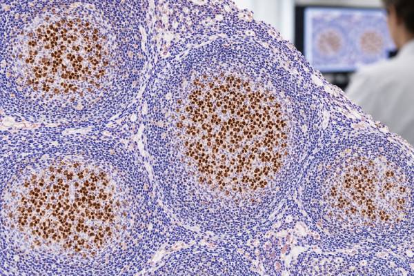 BCL6 IHC Test: Lymphoma Marker, Germinal Center Pattern, and Positive Staining Learn what BCL6 IHC positive staining means, how BCL6 identifies germinal-center patterns in lymphoma, and why BCL6 protein expression differs from gene rearrangement.