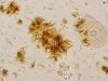 Bilirubin Crystals in Urine: Liver Disease Marker and Abnormal Urine Sediment Bilirubin crystals in urine can signal conjugated bilirubin excretion from liver or bile-duct disease. Learn how they look, what tests confirm the cause, and when follow-up is urgent.