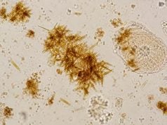 Bilirubin Crystals in Urine: Liver Disease Marker and Abnormal Urine Sediment Bilirubin crystals in urine can signal conjugated bilirubin excretion from liver or bile-duct disease. Learn how they look, what tests confirm the cause, and when follow-up is urgent.