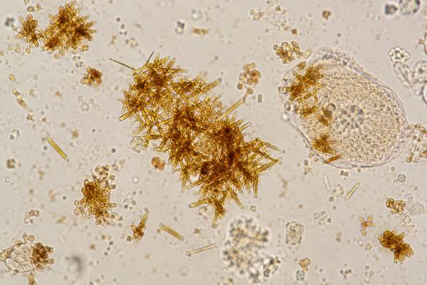 Bilirubin Crystals in Urine: Liver Disease Marker and Abnormal Urine Sediment Bilirubin crystals in urine can signal conjugated bilirubin excretion from liver or bile-duct disease. Learn how they look, what tests confirm the cause, and when follow-up is urgent.