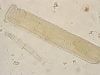 Broad Casts in Urine: Advanced Kidney Disease and Low Urine Flow Broad casts in urine can reflect dilated tubules, low urine flow, and advanced kidney damage. Learn how broad waxy casts differ from other casts and what follow-up tests mean.