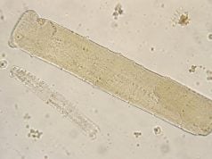 Broad Casts in Urine: Advanced Kidney Disease and Low Urine Flow Broad casts in urine can reflect dilated tubules, low urine flow, and advanced kidney damage. Learn how broad waxy casts differ from other casts and what follow-up tests mean.