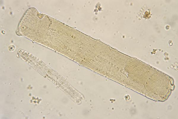 Broad Casts in Urine: Advanced Kidney Disease and Low Urine Flow Broad casts in urine can reflect dilated tubules, low urine flow, and advanced kidney damage. Learn how broad waxy casts differ from other casts and what follow-up tests mean.