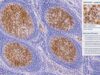CD10 IHC Test: Follicular Lymphoma, Germinal Center Marker, and Positive Staining Learn what a positive CD10 IHC result means in follicular lymphoma and other lymphomas, how germinal center staining is interpreted, and why companion tests matter.