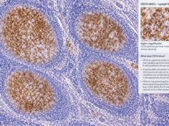 CD10 IHC Test: Follicular Lymphoma, Germinal Center Marker, and Positive Staining Learn what a positive CD10 IHC result means in follicular lymphoma and other lymphomas, how germinal center staining is interpreted, and why companion tests matter.