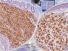 CD56 IHC Test: Neuroendocrine Tumor, NK Cell Tumor, and Positive Staining Learn what CD56 IHC positivity means in neuroendocrine tumors and NK-cell neoplasms, including staining patterns, marker panels, diagnostic pitfalls, and next steps.